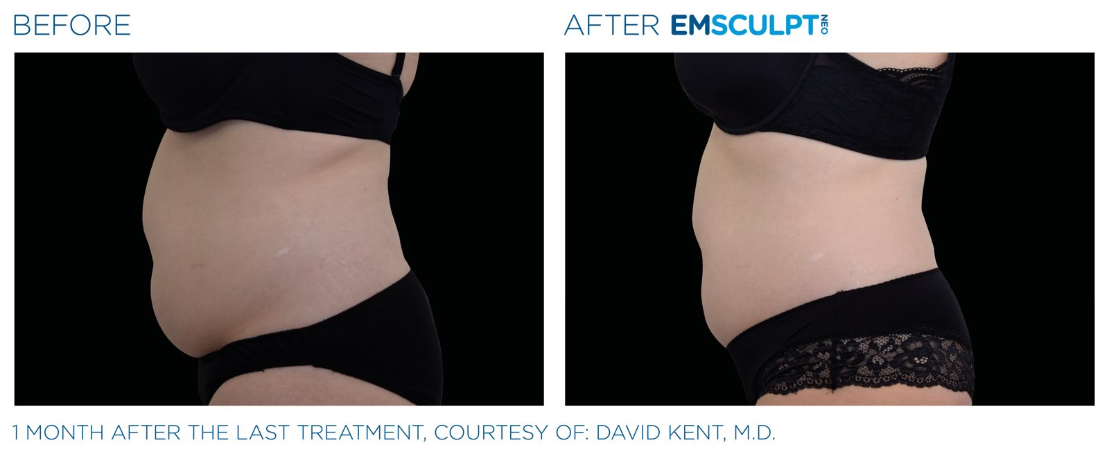 Emsculpt Neo before and after, female abdomen, manufacturer case courtesy of BTL