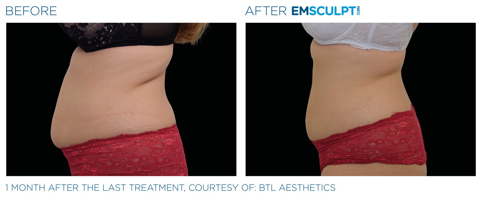 Emsculpt Neo before and after, female abdomen, manufacturer case courtesy of BTL