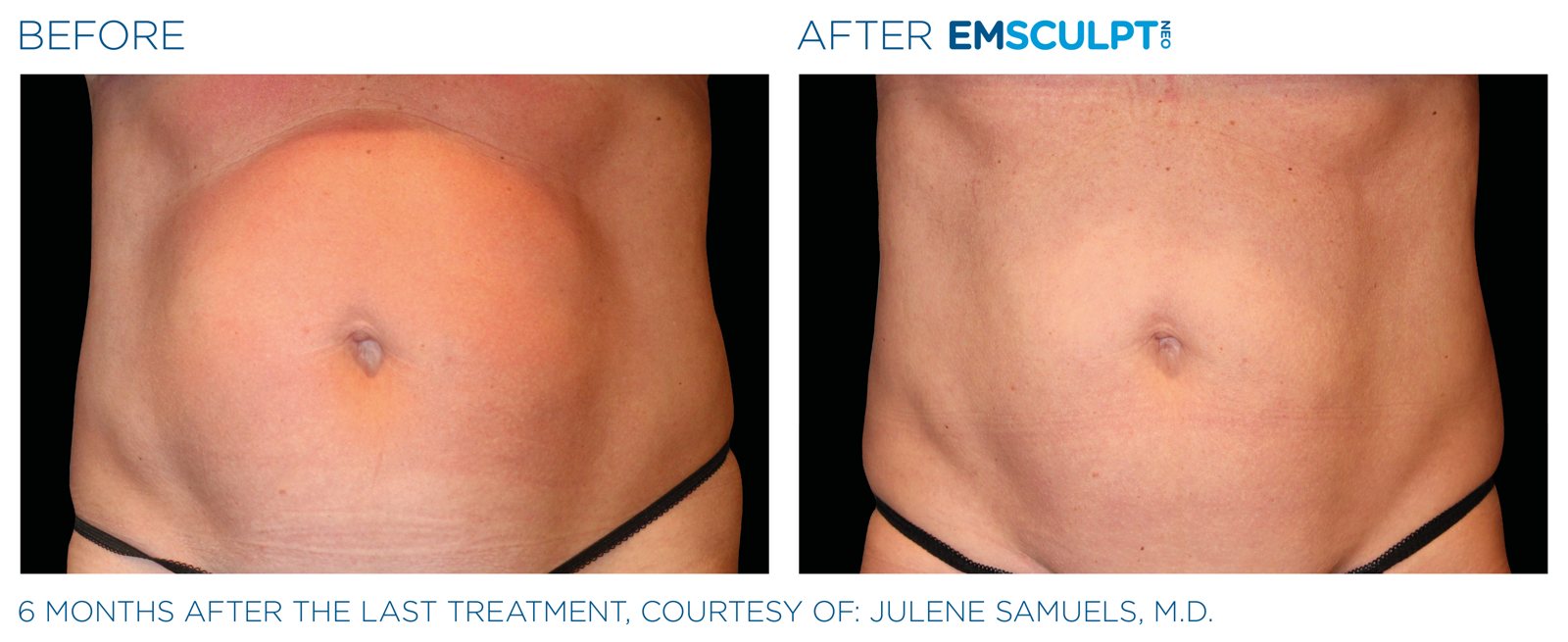 Emsculpt Neo before and after, female abdomen, manufacturer case courtesy of BTL
