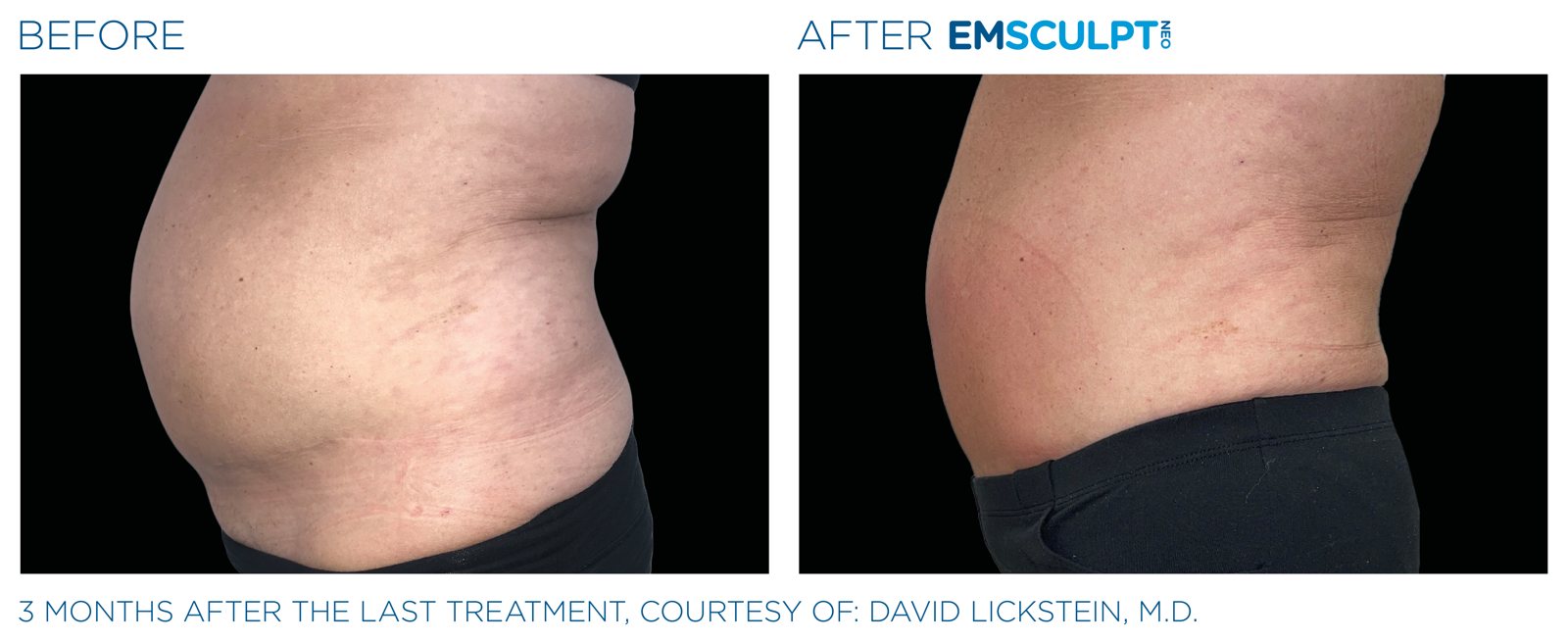 Emsculpt Neo before and after, female abdomen, manufacturer case courtesy of BTL