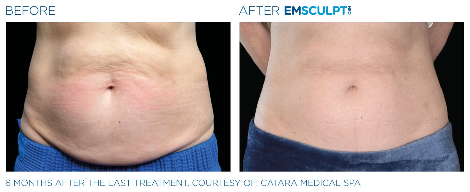 Emsculpt Neo before and after, female abdomen, manufacturer case courtesy of BTL