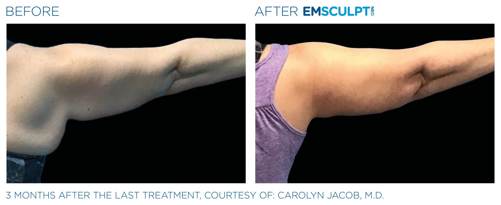 Emsculpt Neo before and after, upper arms, manufacturer case courtesy of BTL