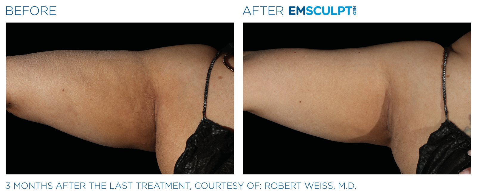 Emsculpt Neo before and after, upper arms, manufacturer case courtesy of BTL