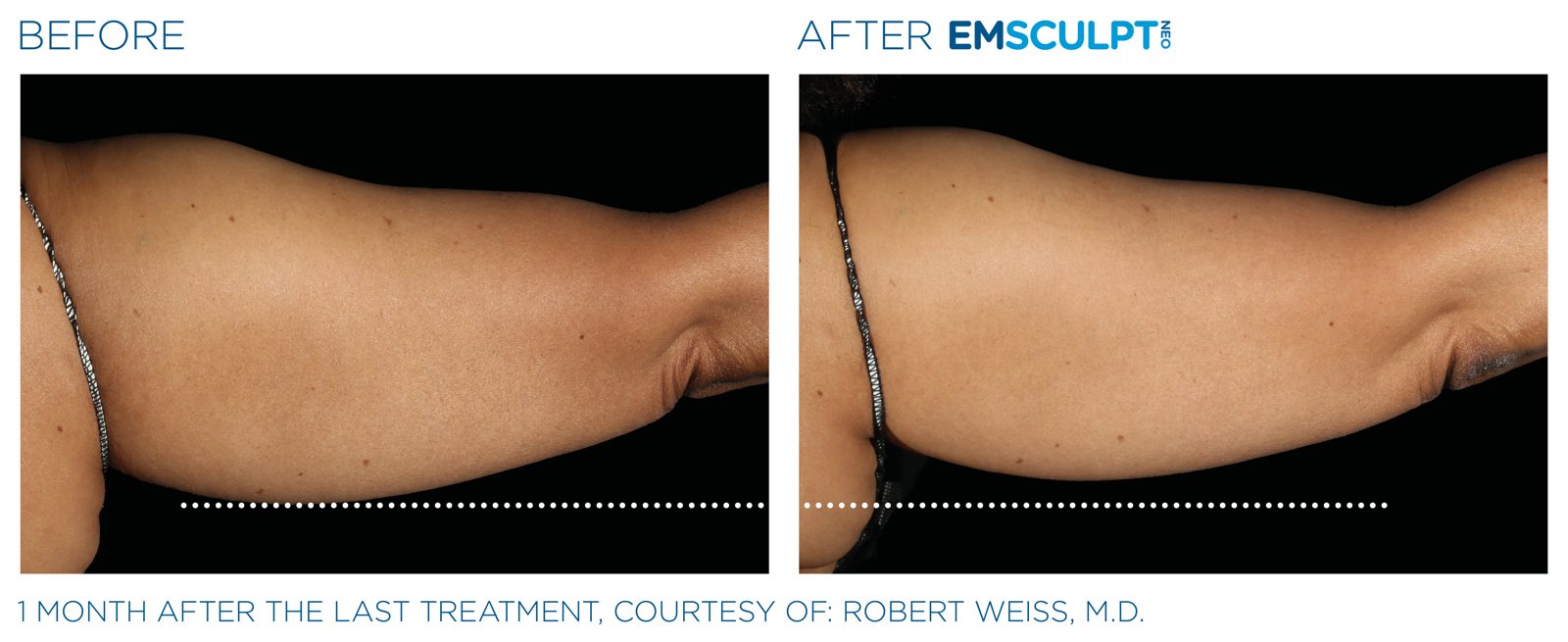 Emsculpt Neo before and after, upper arms, manufacturer case courtesy of BTL