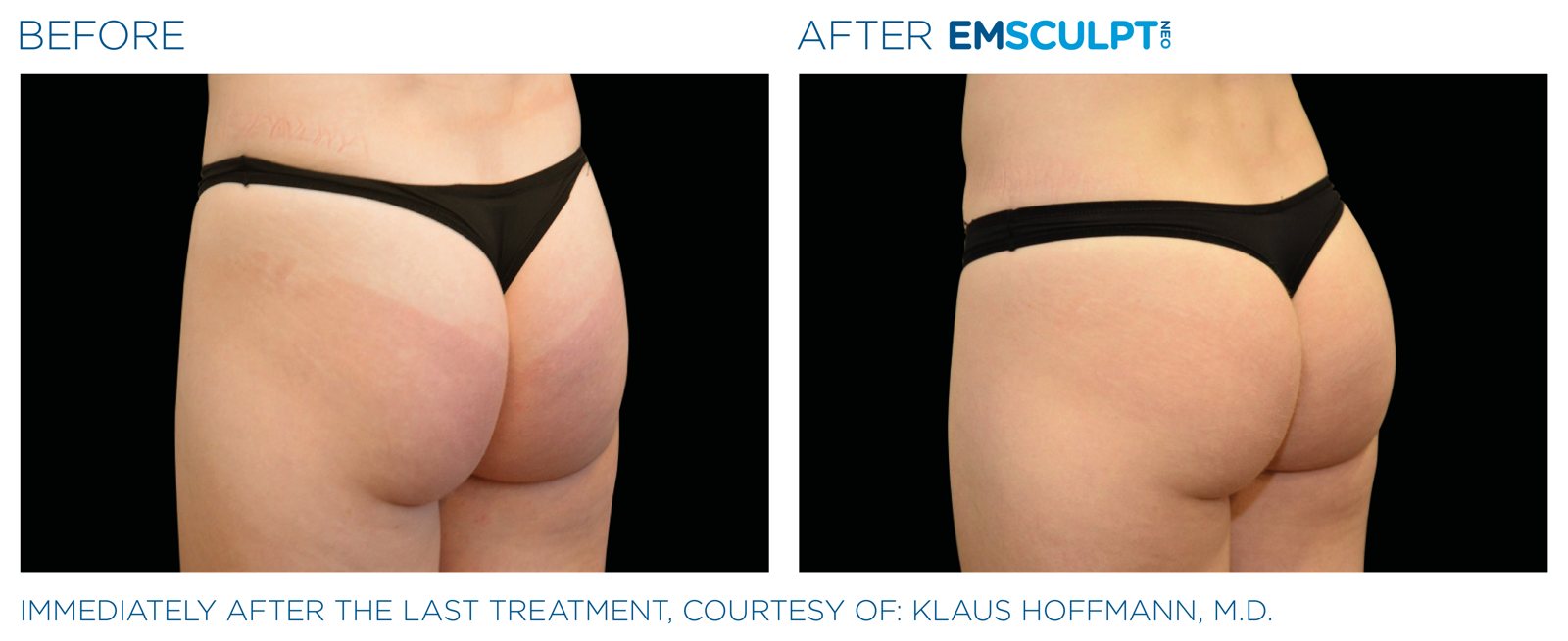 Emsculpt Neo before and after, buttocks, manufacturer case courtesy of BTL