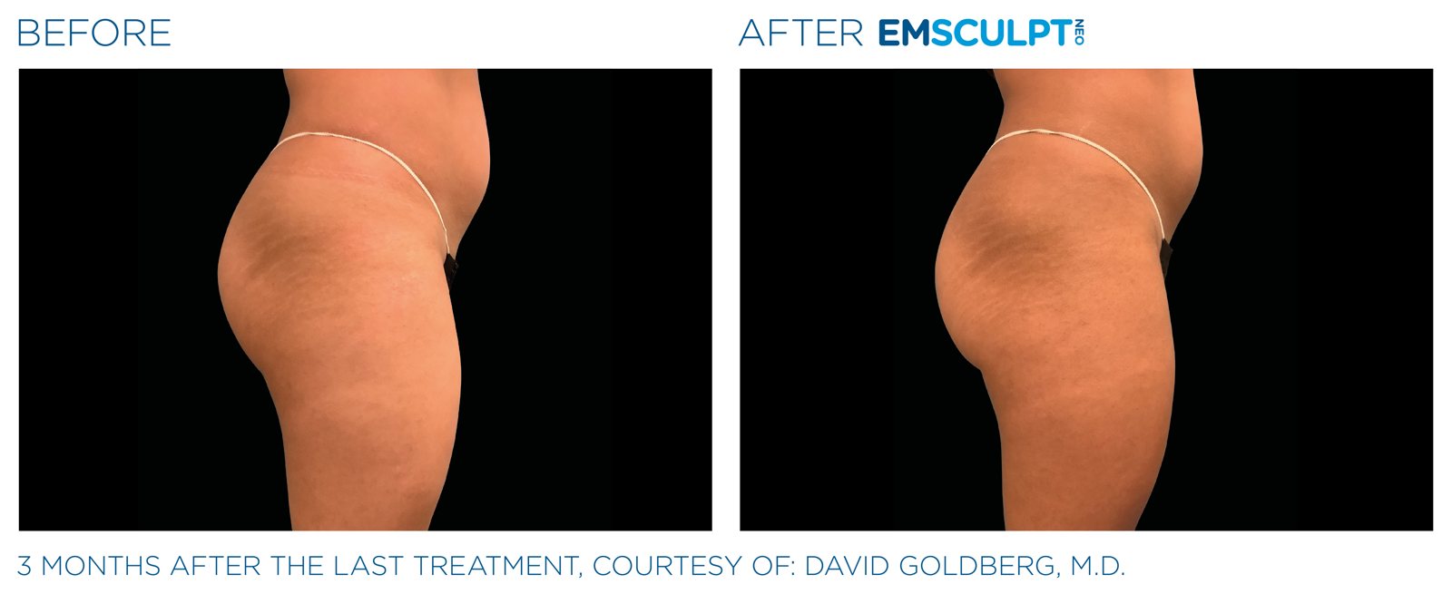 Emsculpt Neo before and after, buttocks, manufacturer case courtesy of BTL