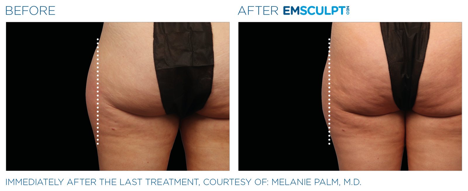 Emsculpt Neo before and after, outer thighs, manufacturer case courtesy of BTL