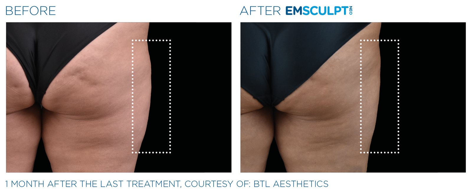 Emsculpt Neo before and after, outer thighs, manufacturer case courtesy of BTL