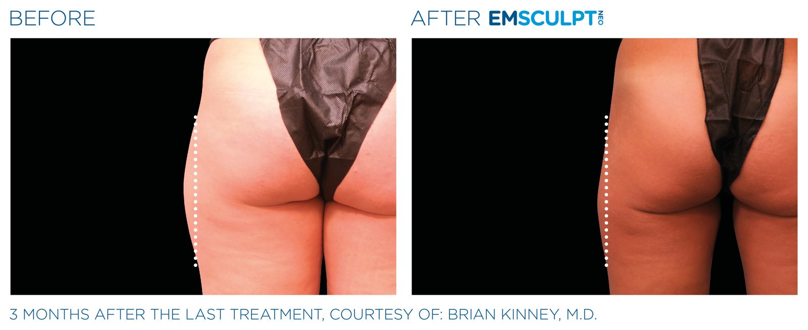 Emsculpt Neo before and after, outer thighs, manufacturer case courtesy of BTL