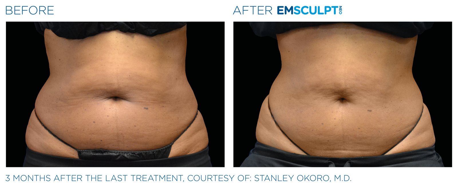 Emsculpt Neo before and after, male abdomen (side view), manufacturer case courtesy of BTL